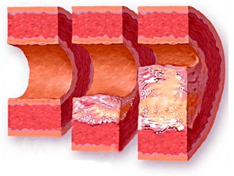 Атеросклероз, диагностика и лечение - медицинский центр «Олмед»