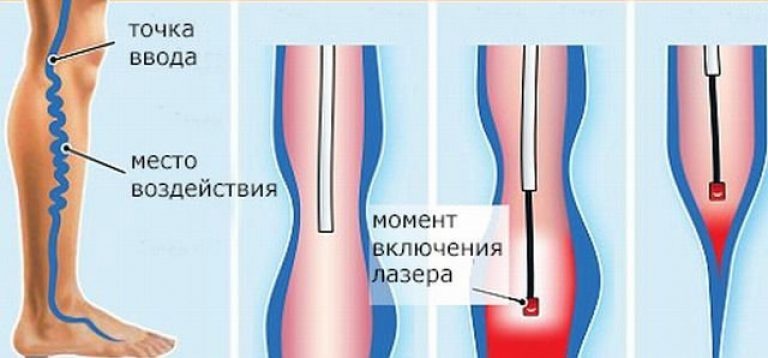 Эндовенозная лазерная коагуляция вен нижних конечностей